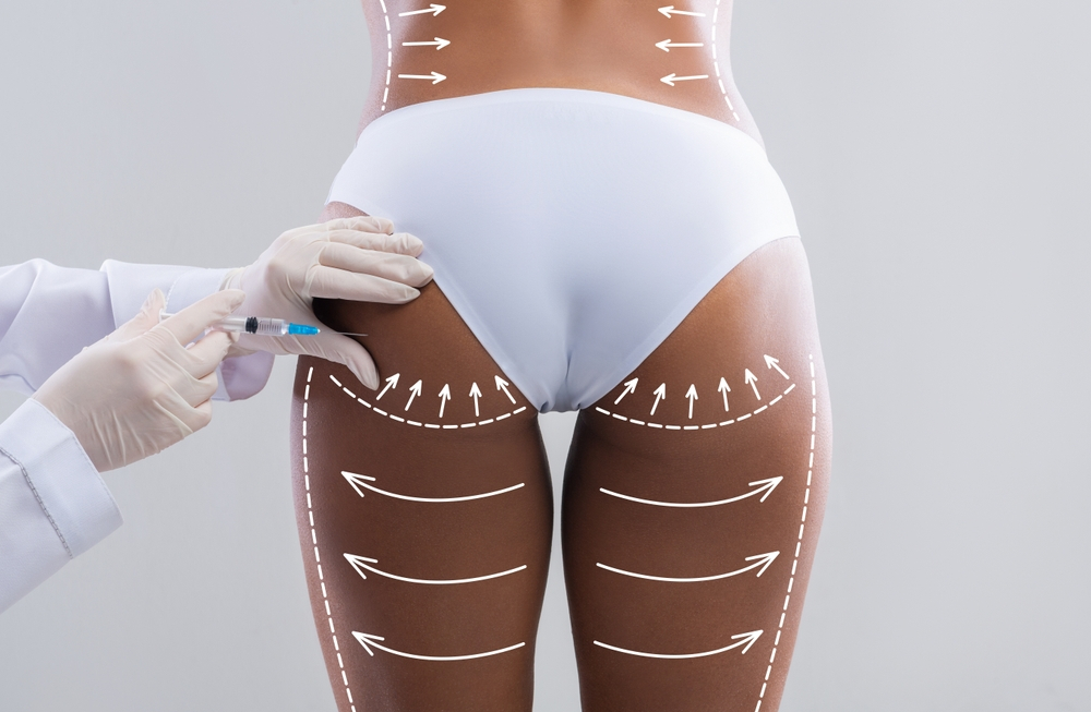What is Butt Aesthetics (BBL)? Butt Aesthetics (BBL) Surgery Prices
