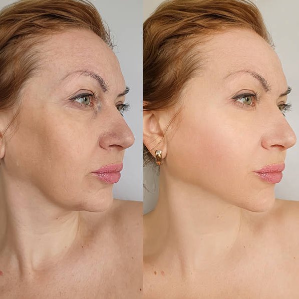 before after